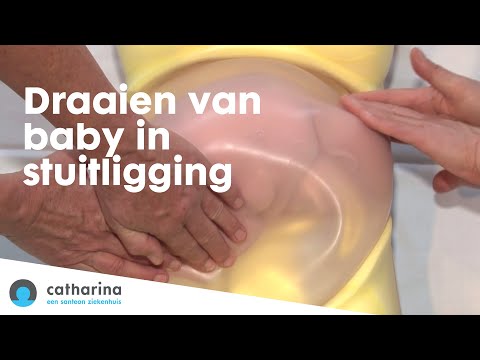 Stuit / stuitligging: het draaien van baby in stuitligging naar hoofdligging Catharina Ziekenhuis