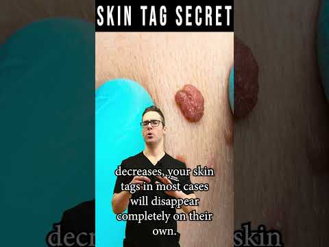 How To Remove Skin Tags FOREVER! [Skin Tag Removal Secret]
