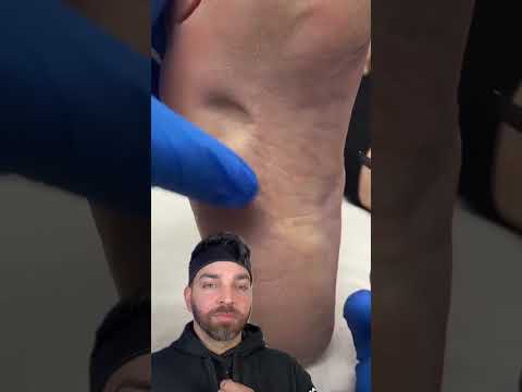 Painful BUMP on the Bottom of the Foot | Doctorly #shorts